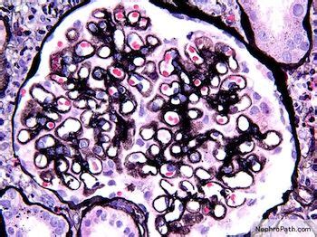 spike and dome appearance membranous nephropathy